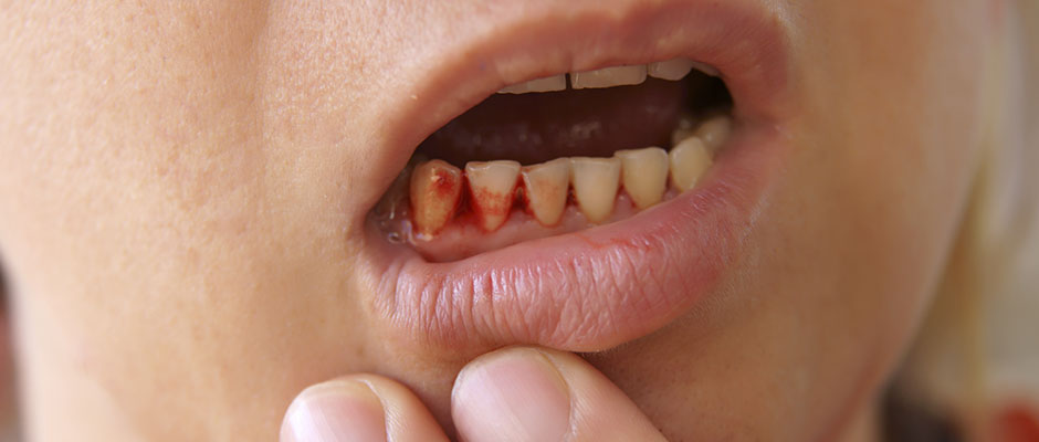 Bleeding gums are never normal