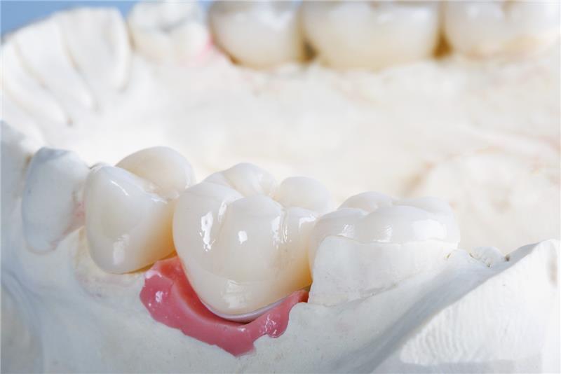 Dental Crowns: What They Are and When You Might Need One