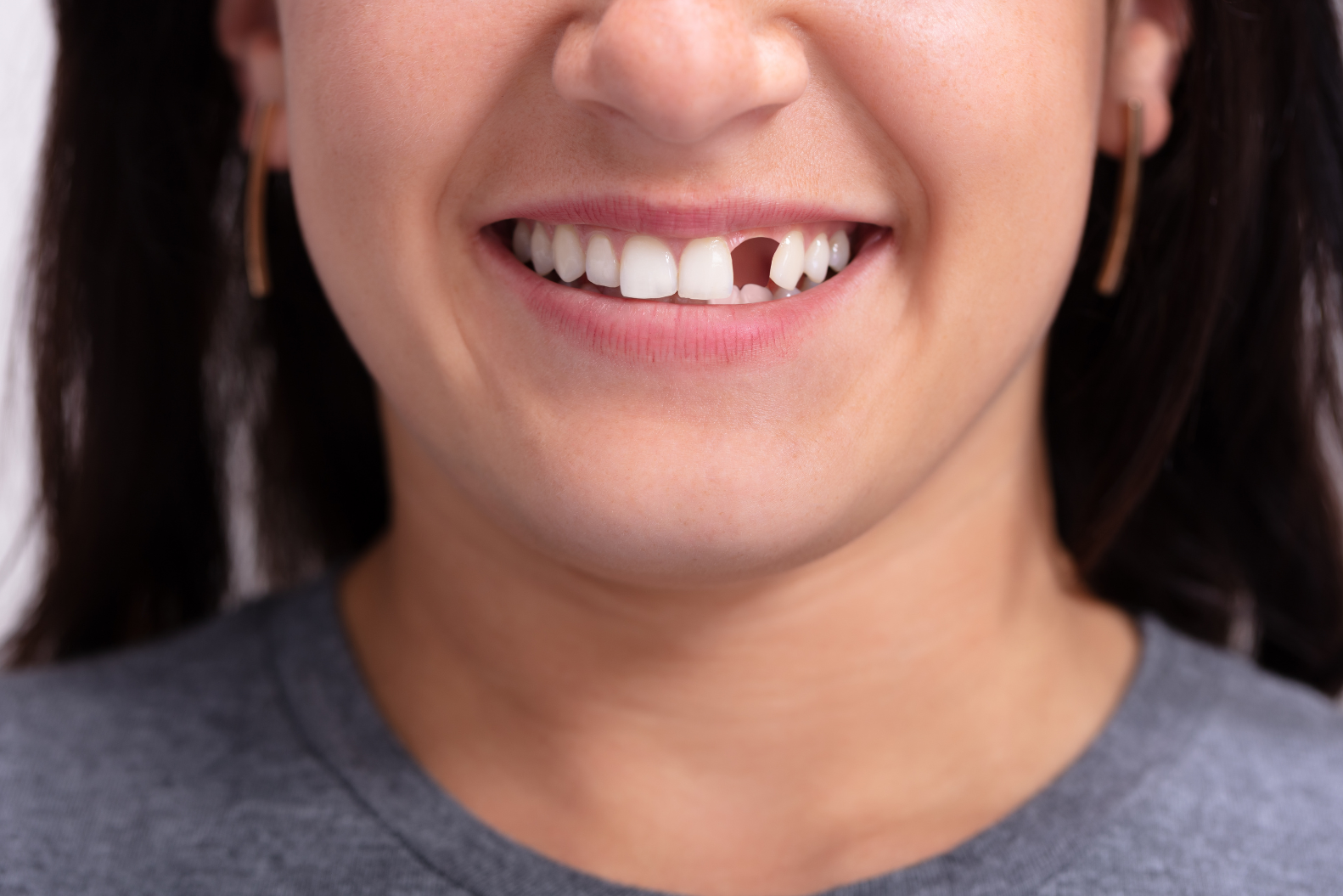The Importance of Replacing Missing Teeth